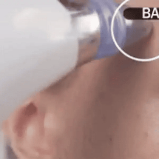 DERMA SUCTION | Pore Vacuum Cleaner